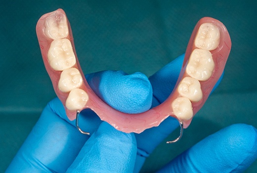 Partial dentures